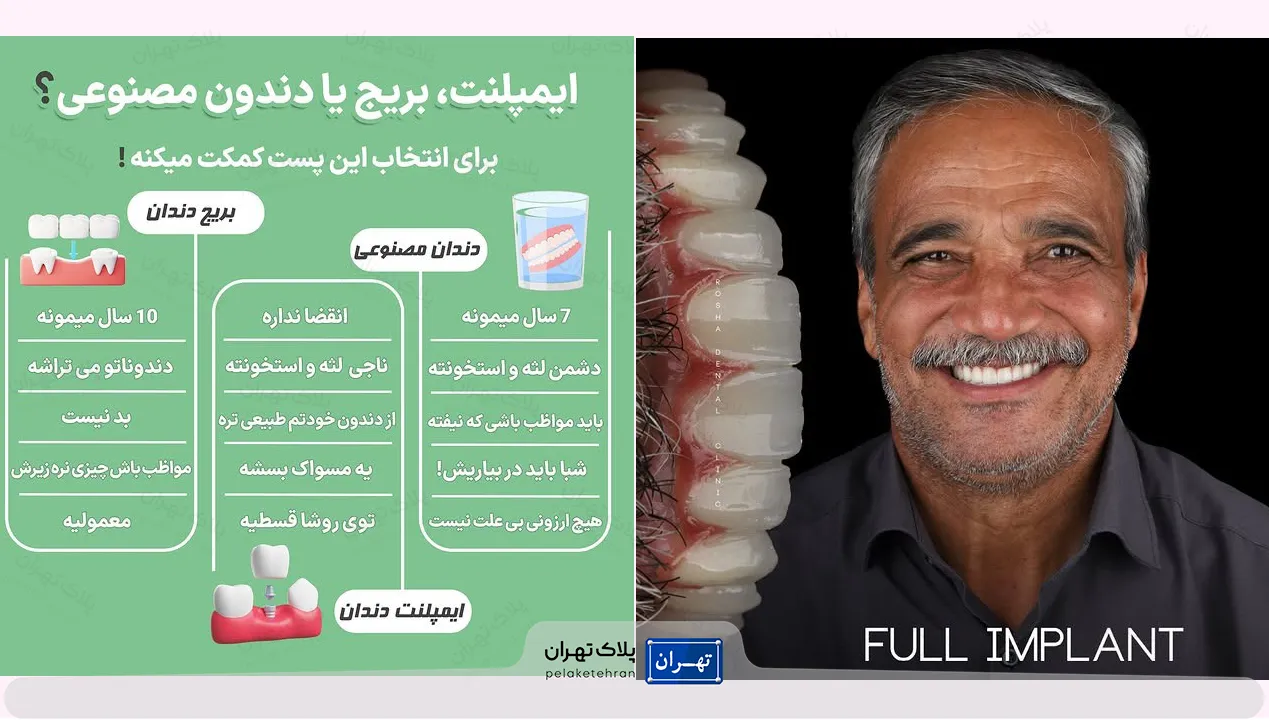 ایمپلنت مرکز دندانپزشکی و ایمپلنت در سعادت آباد روشا