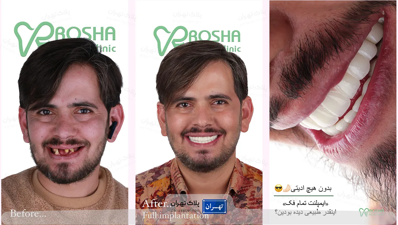 مرکز دندانپزشکی و ایمپلنت در سعادت آباد روشا