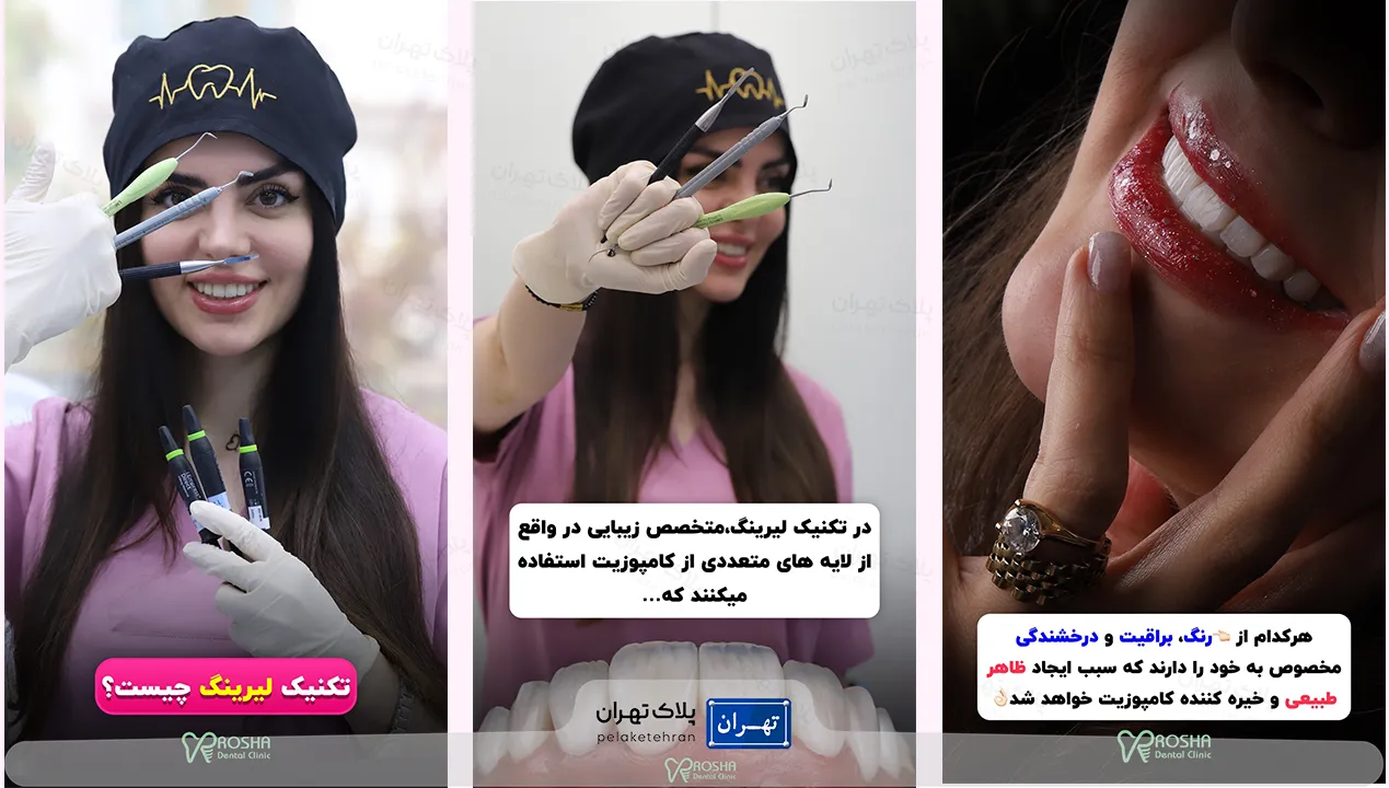 تکنیک لیرینگ در مرکز دندانپزشکی و ایمپلنت در سعادت آباد روشا