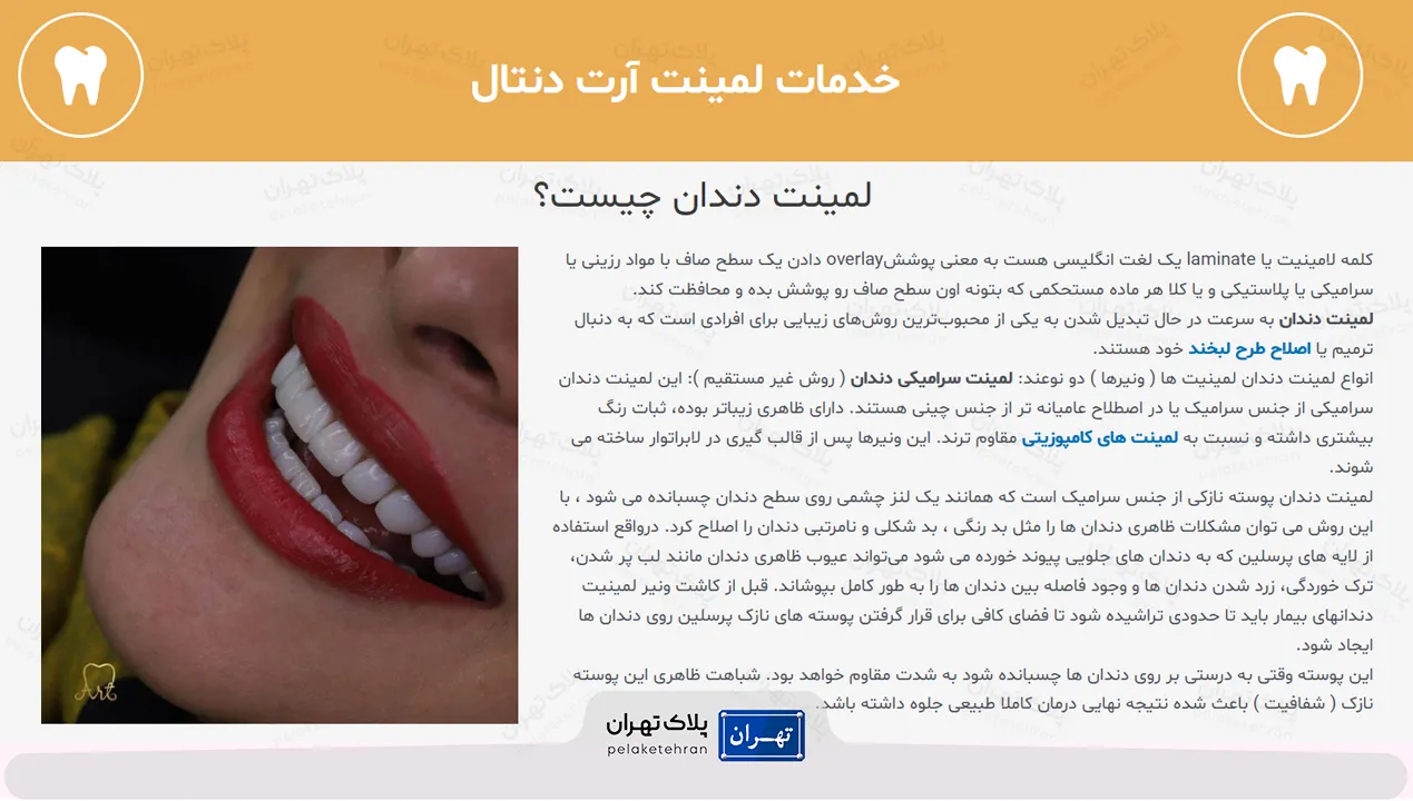 لمینت در کلینیک دندانپزشکی آرت (دکتر طاهره شاکری اصیل)