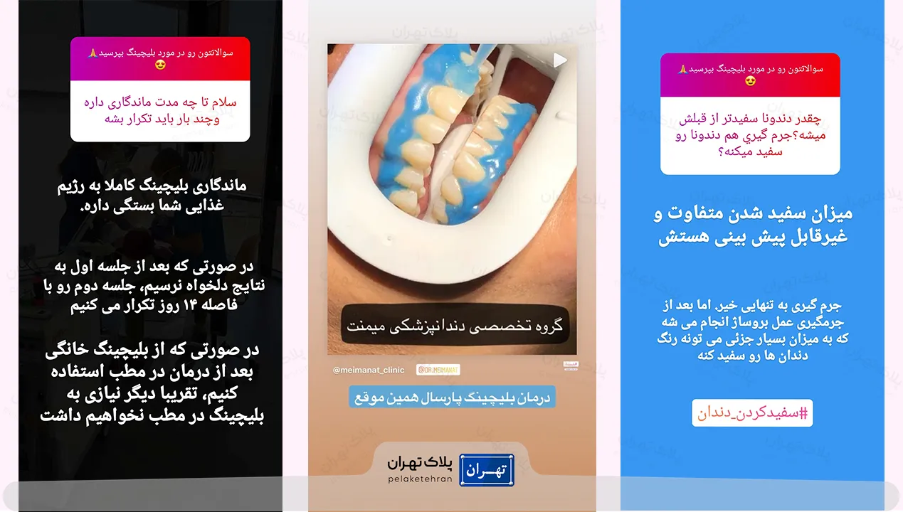 بلیچینگ در کلینیک دندانپزشکی دکتر میمنت