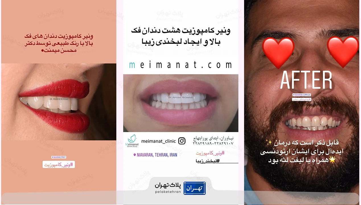 کامپوزیت در کلینیک دندانپزشکی دکتر میمنت